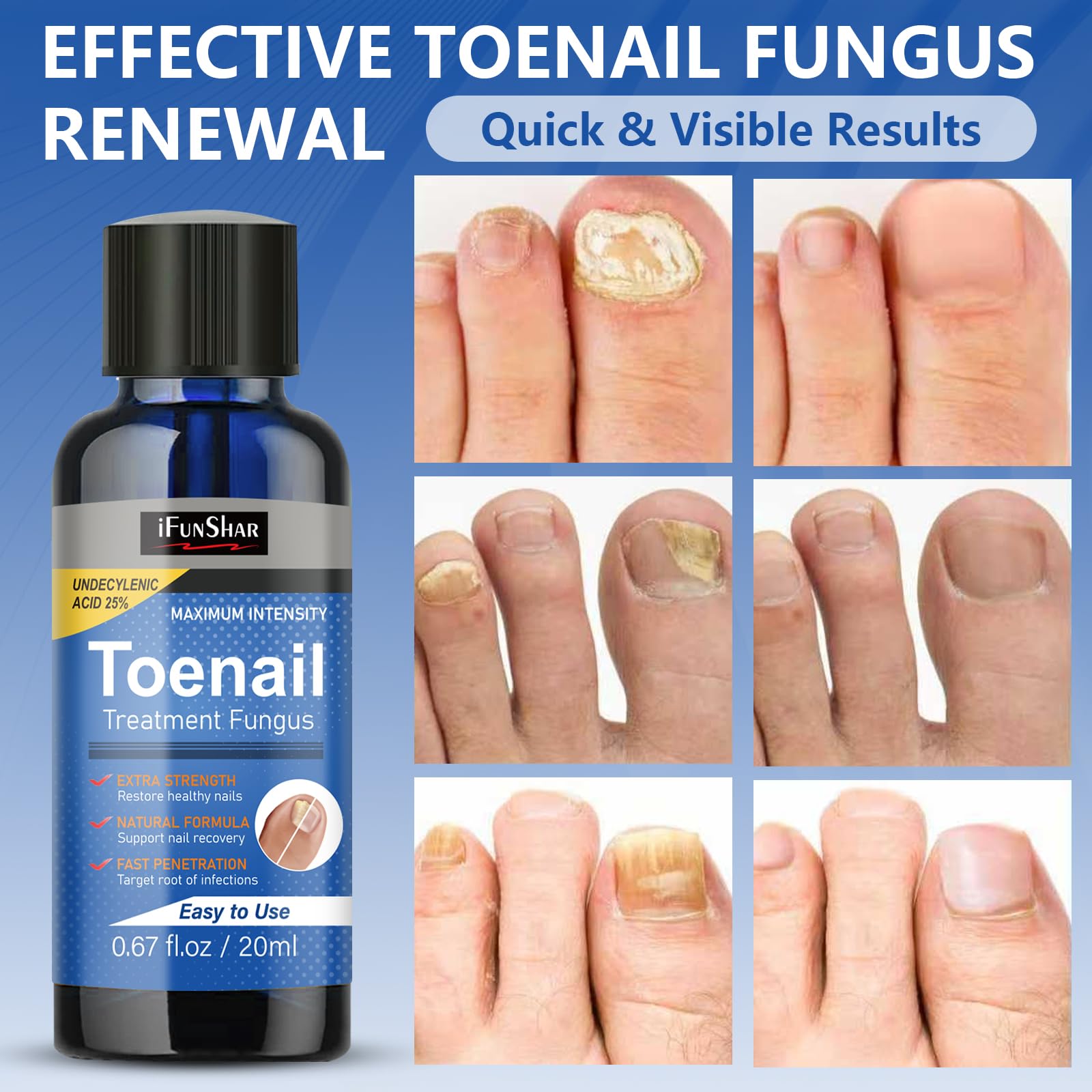 IFUNSHAR-treated nail showing smoother appearance.