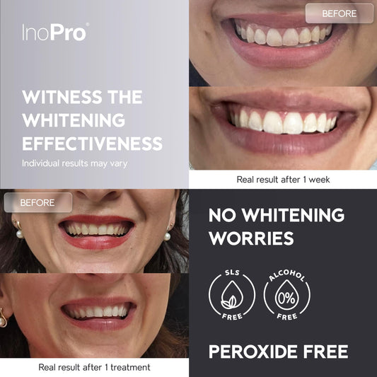 Close-up of InoPro strips being applied for sensitive teeth.