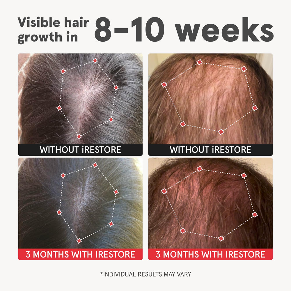 iRestore capsules close-up showing daily nutrient support for follicles