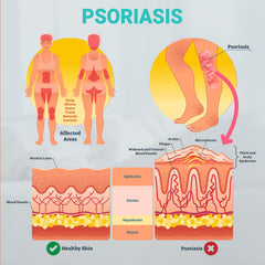 Hand applying Ishancare Psoriasis Cream for targeted care