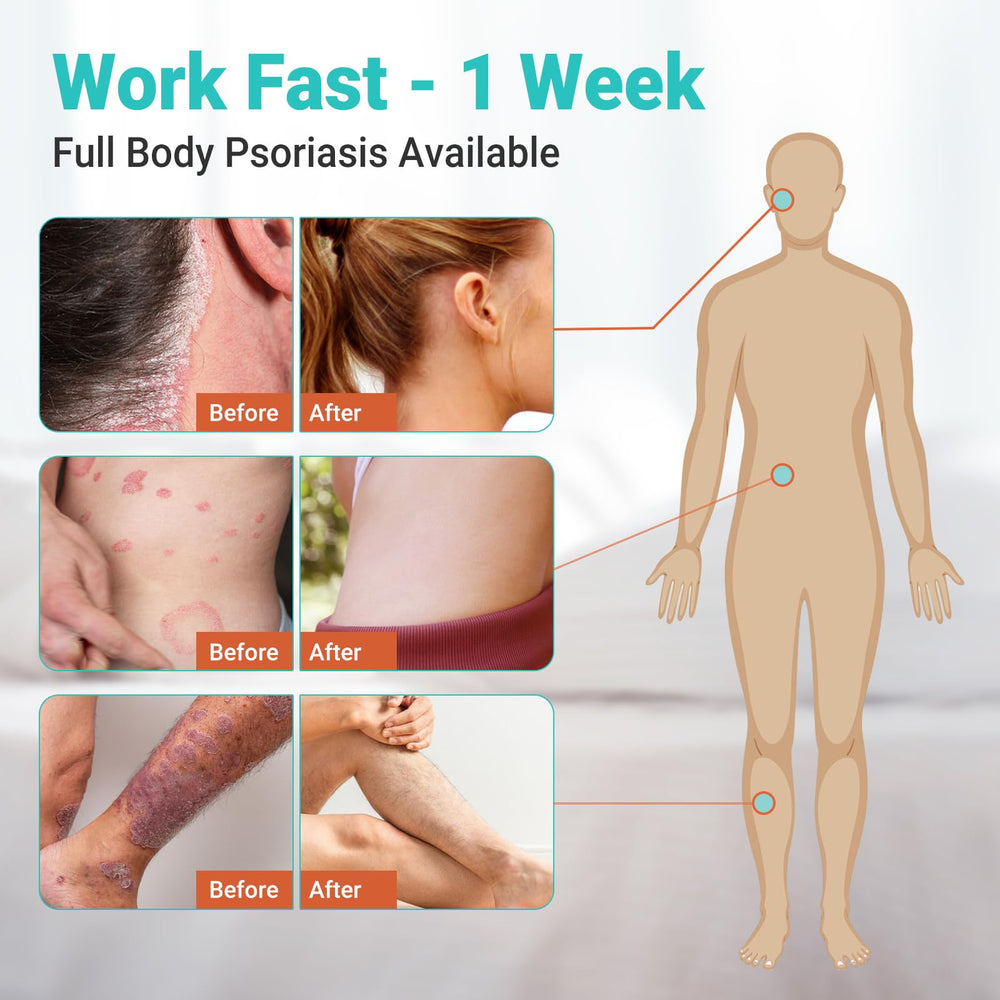 Ishancare Psoriasis Cream in a bathroom scene for daily skincare routine