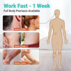 Ishancare Psoriasis Cream in a bathroom scene for daily skincare routine