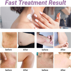 ishancare Urticaria Cream texture close-up reveals non-greasy absorption