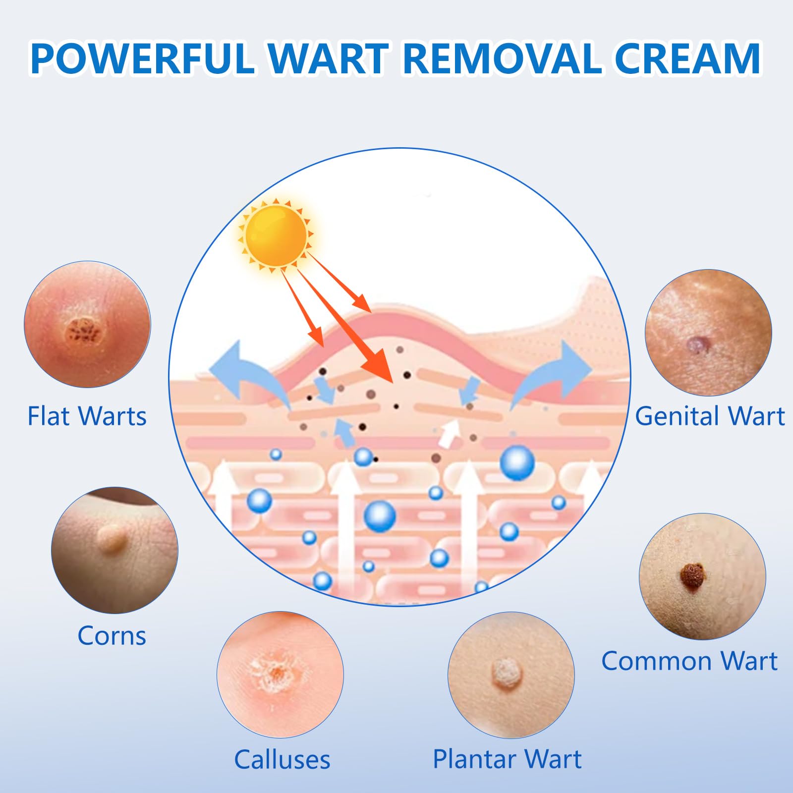 KIbabyDI Freeze-off technology targets warts for non-invasive removal at home.