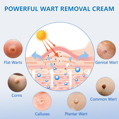 KIbabyDI Freeze-off technology targets warts for non-invasive removal at home.