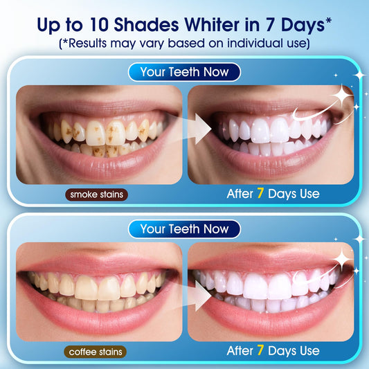 KOAEO desensitizing pens with hydroxyapatite soothe sensitivity during whitening
