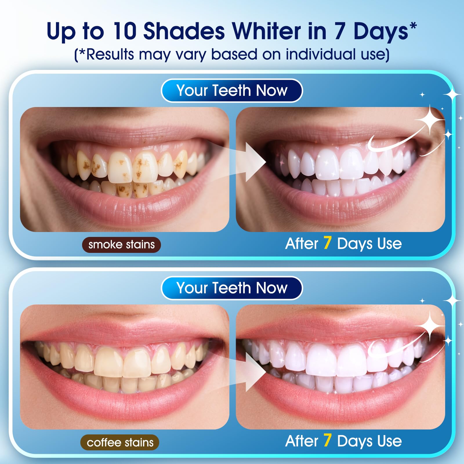 KOAEO whitening pens close-up showing precise enamel targeting.