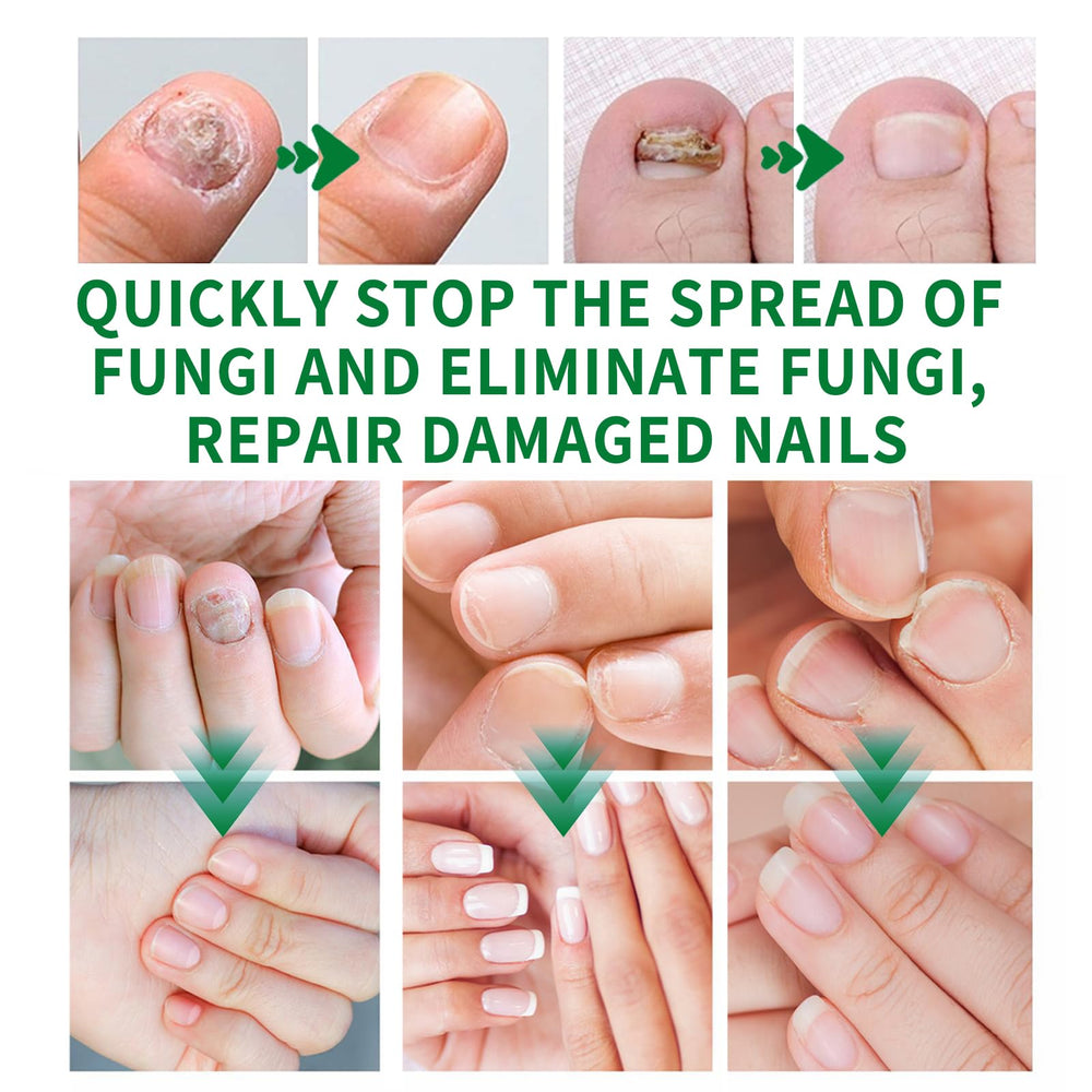 KUNLEN Nail Fungus Gel application on nail; helps hydration and shine.