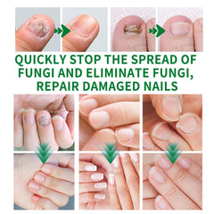 KUNLEN Nail Fungus Gel application on nail; helps hydration and shine.