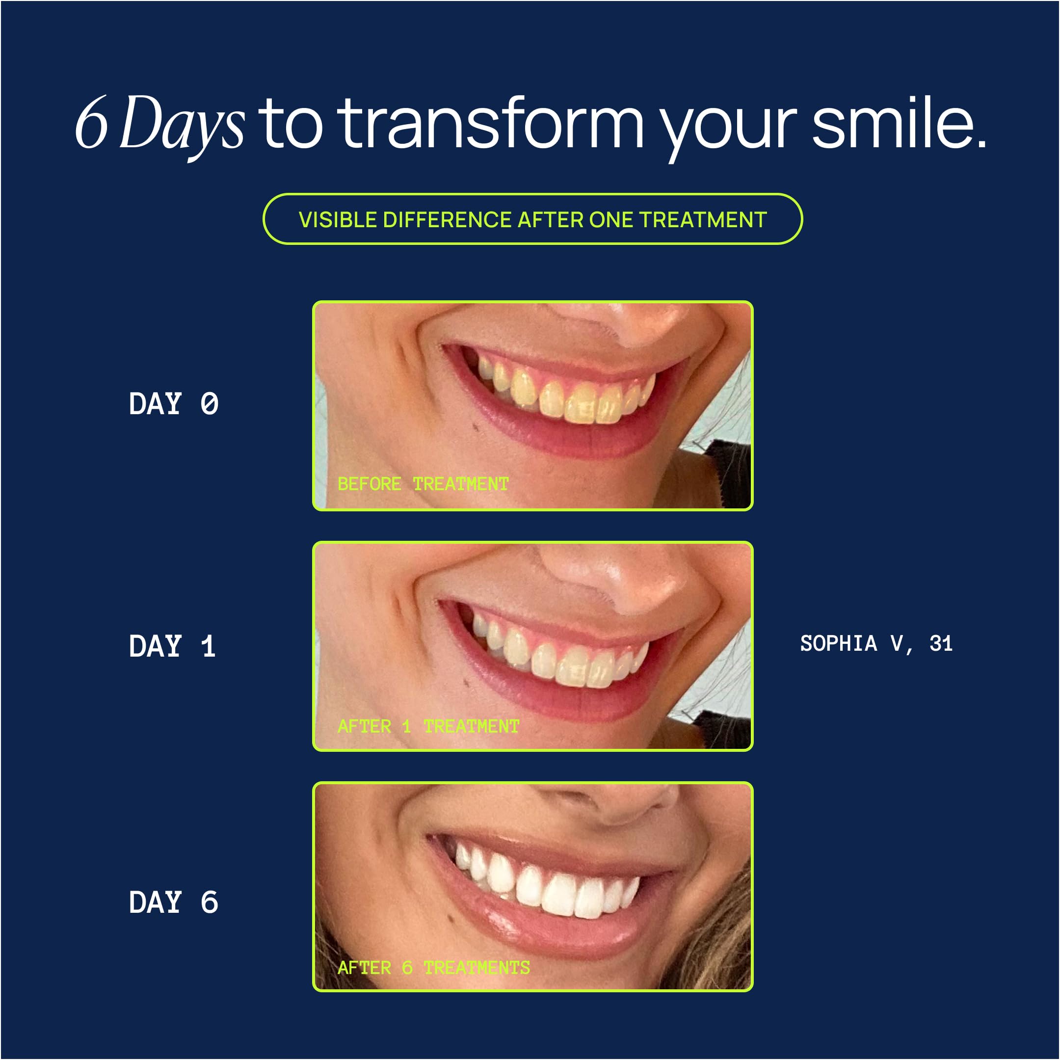 Laughland Original Teeth Whitening Kit 8-percent hydrogen peroxide for effective whitening.