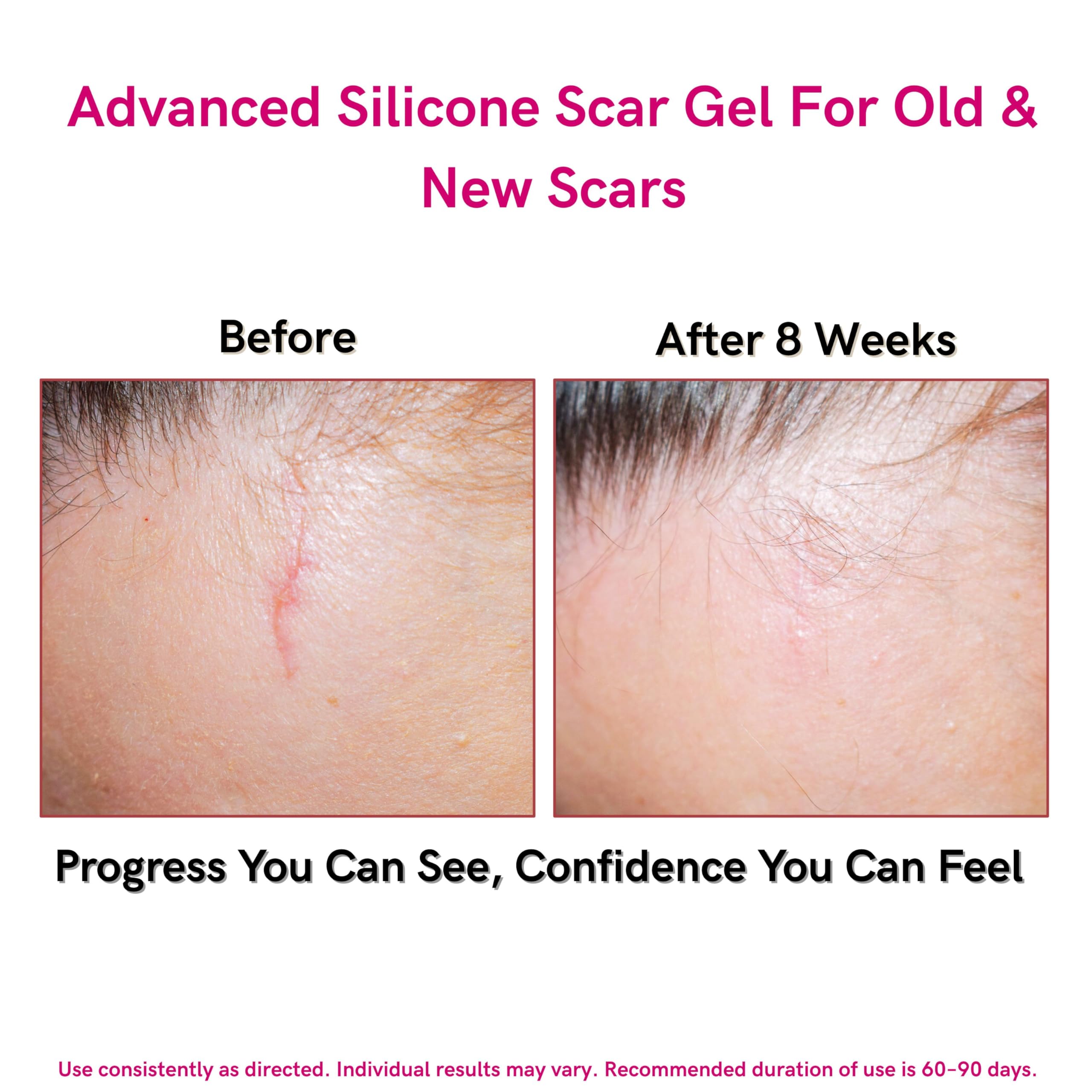 LIPOELASTIC scar gel texture close-up shows non-greasy finish.