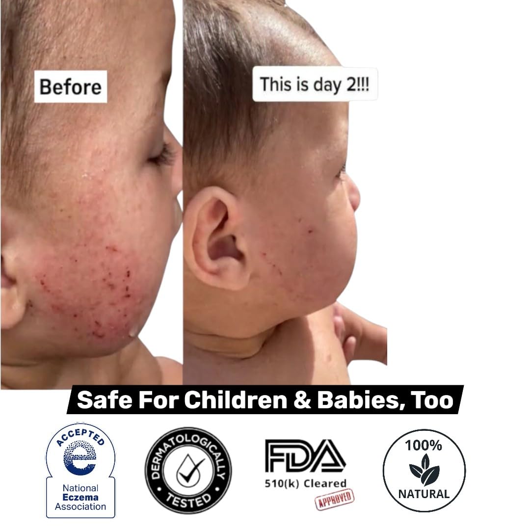 Loma Lux Eczemol suitable for kids and adults, gentle spray