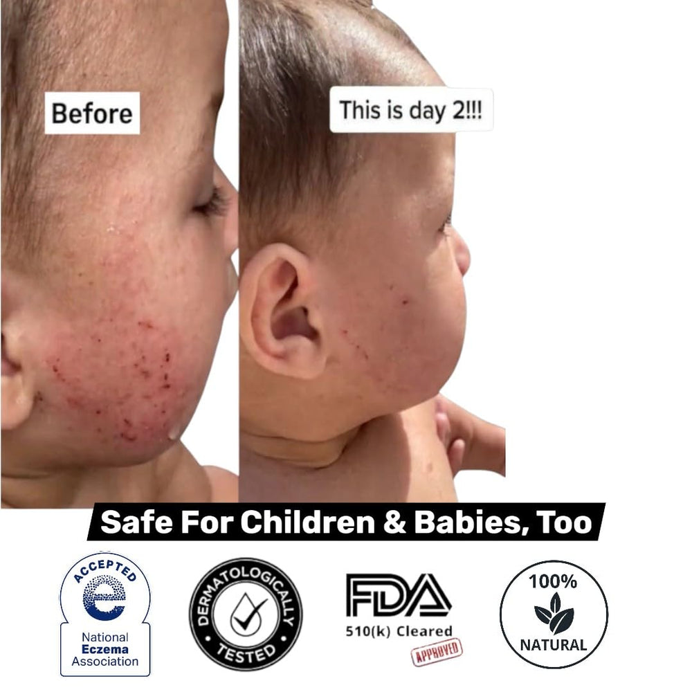 Loma Lux Eczemol suitable for kids and adults, gentle spray