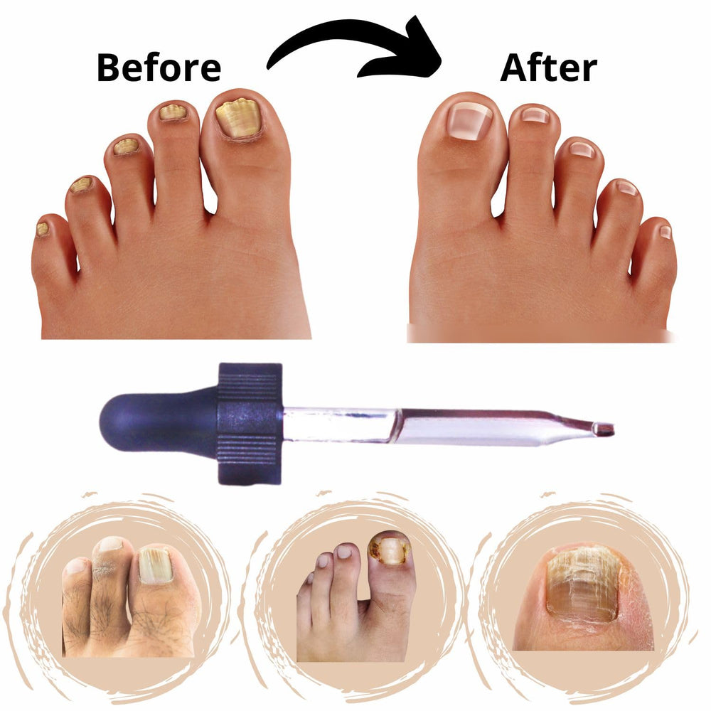 LucaED nails showing discoloration before treatment