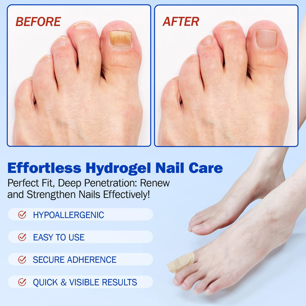 Mcukv toenail patches travel-friendly pack for on-the-go maintenance.