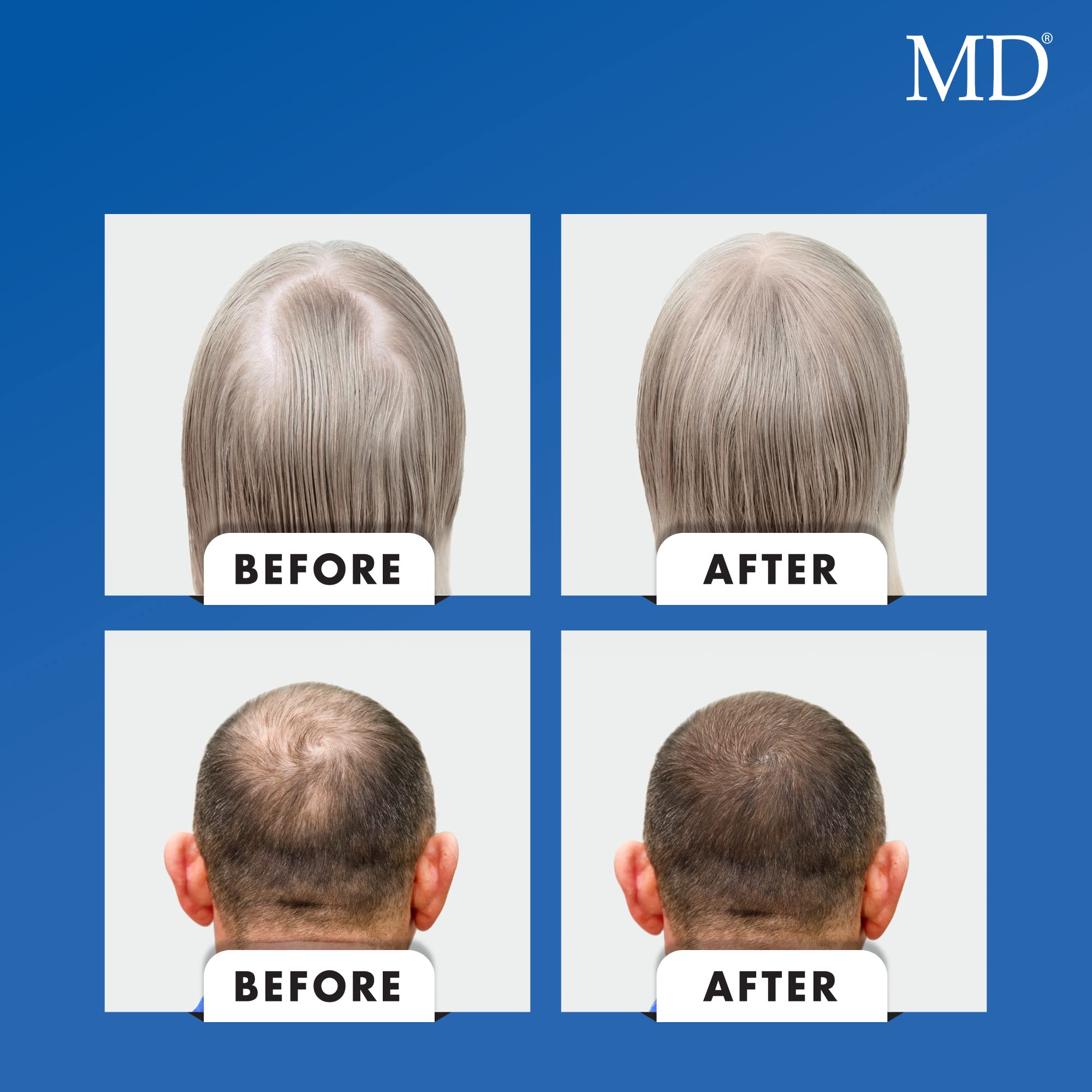 MD Nutri flaxseed powder represents scalp and hair root nourishment