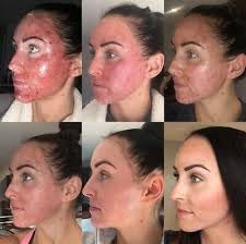 MEBO Burn Cream aftercare use for skin support