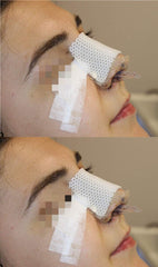 Mediss nasal-splint on nose offers external support after surgery