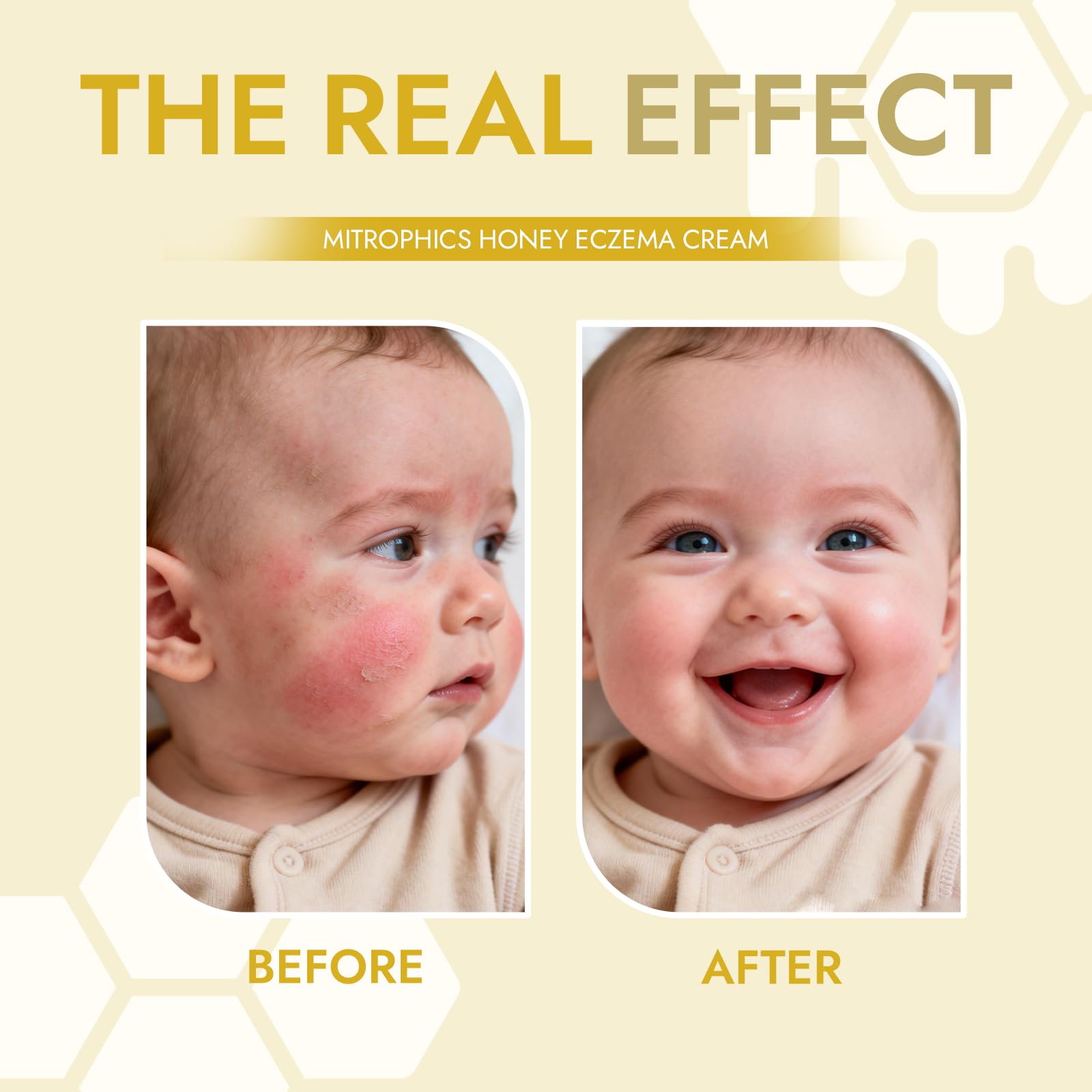 Mitrophics Honey Eczema Cream applied to the face to calm delicate areas.
