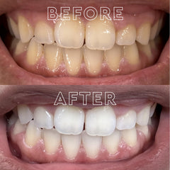 MOON Midnight Mint strip dissolving on tooth shows fast 15-minute action.