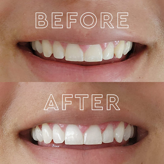 MOON peppermint whitening strips ready for two-week treatment at home.