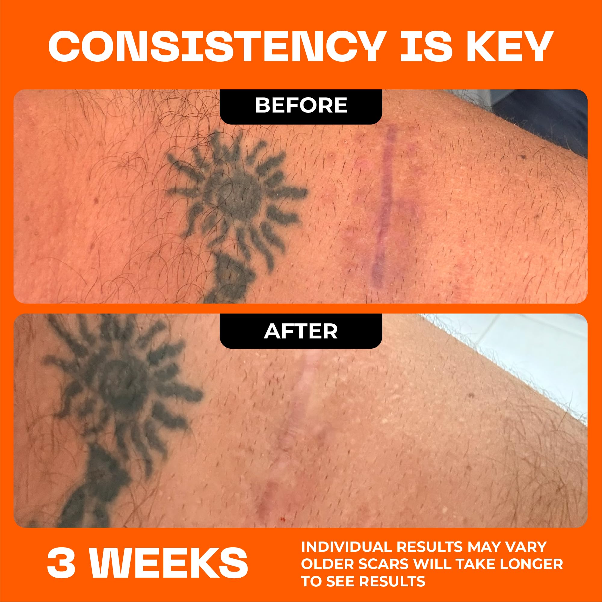 Motivo Scar Care used on facial scars for daily wear.