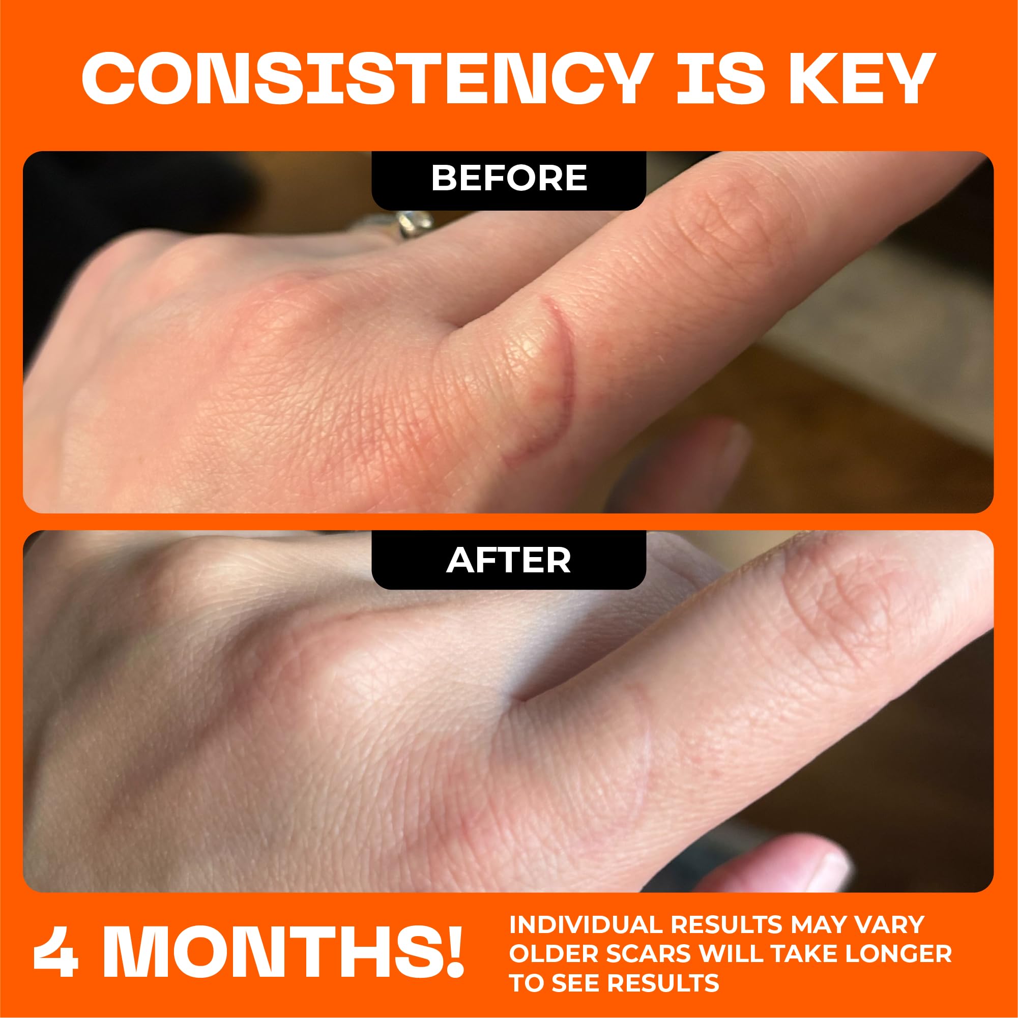 Hands applying Motivo Scar Care cream on a scar.