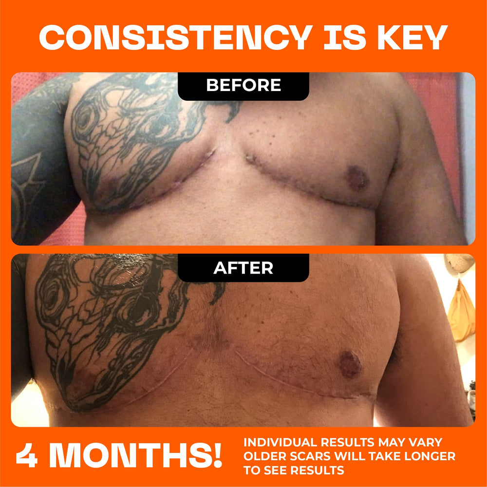 Motivo Scar Care designed for discreet wear under clothing.