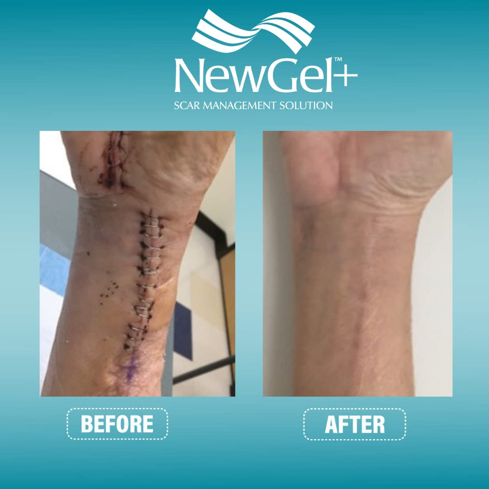 MyNewGel Advanced scar tape 1 mm thick for hydration and occlusion.