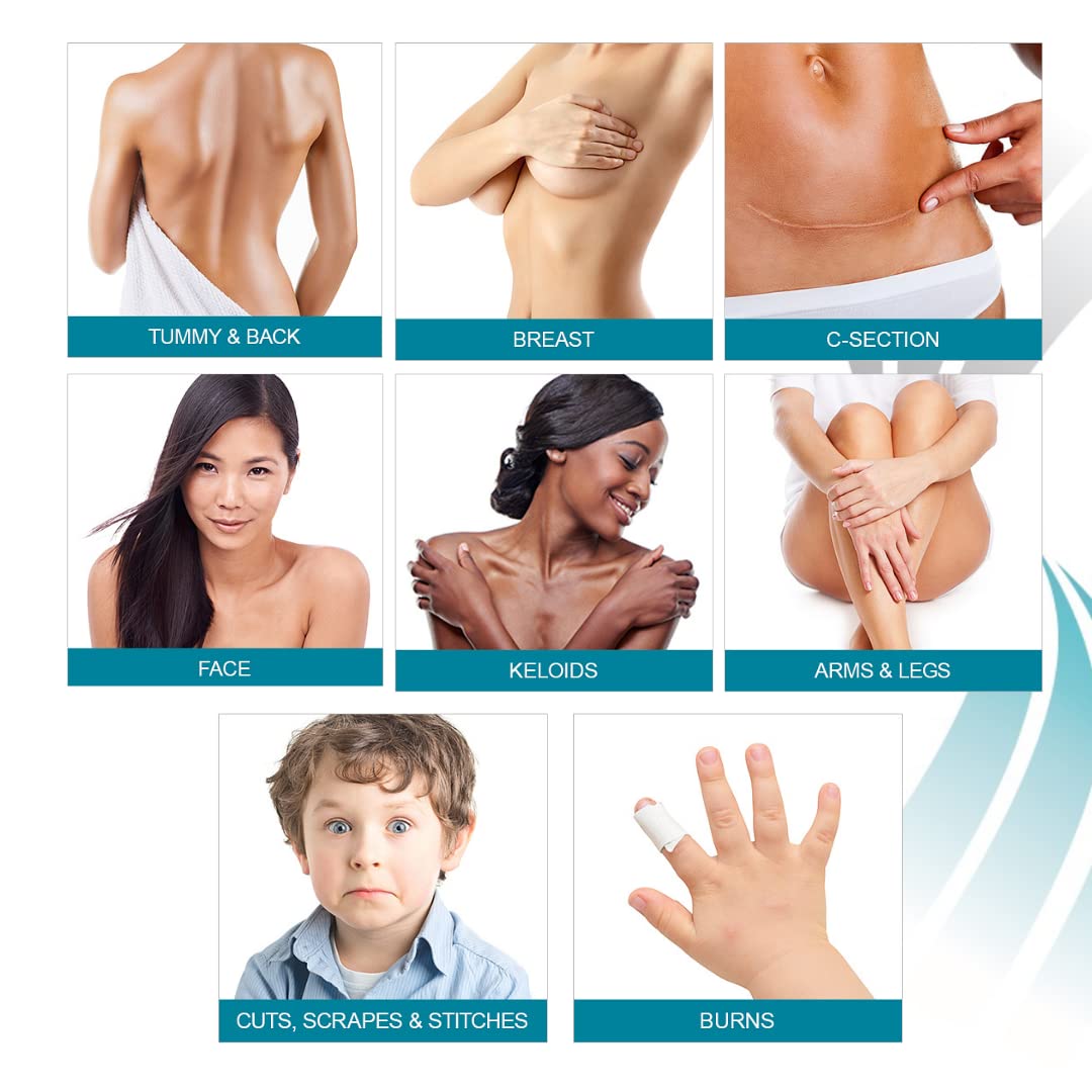 MyNewGel Advanced scar tape cut to fit curves and contours.