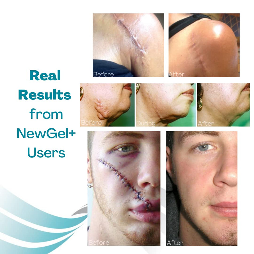 MyNewGel daily scar-care routine with adhesive tape included.