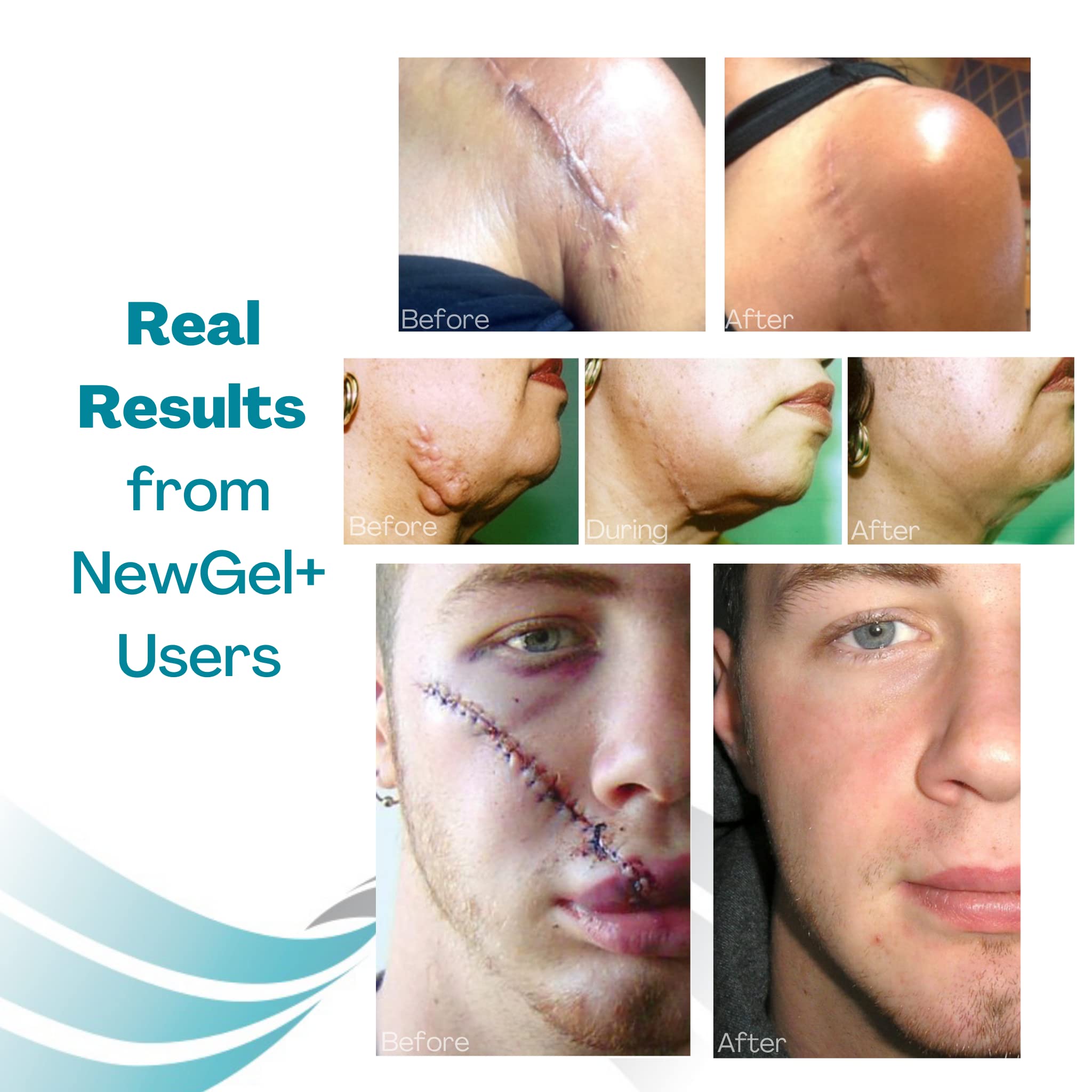 MyNewGel beige anchor sheet suitable for FTM top surgery scars.