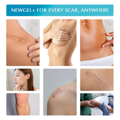 MyNewGel produced in the USA silicone scar sheets.