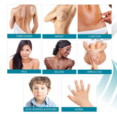 MyNewGel Advanced tape cut-to-fit for scars along sutures.