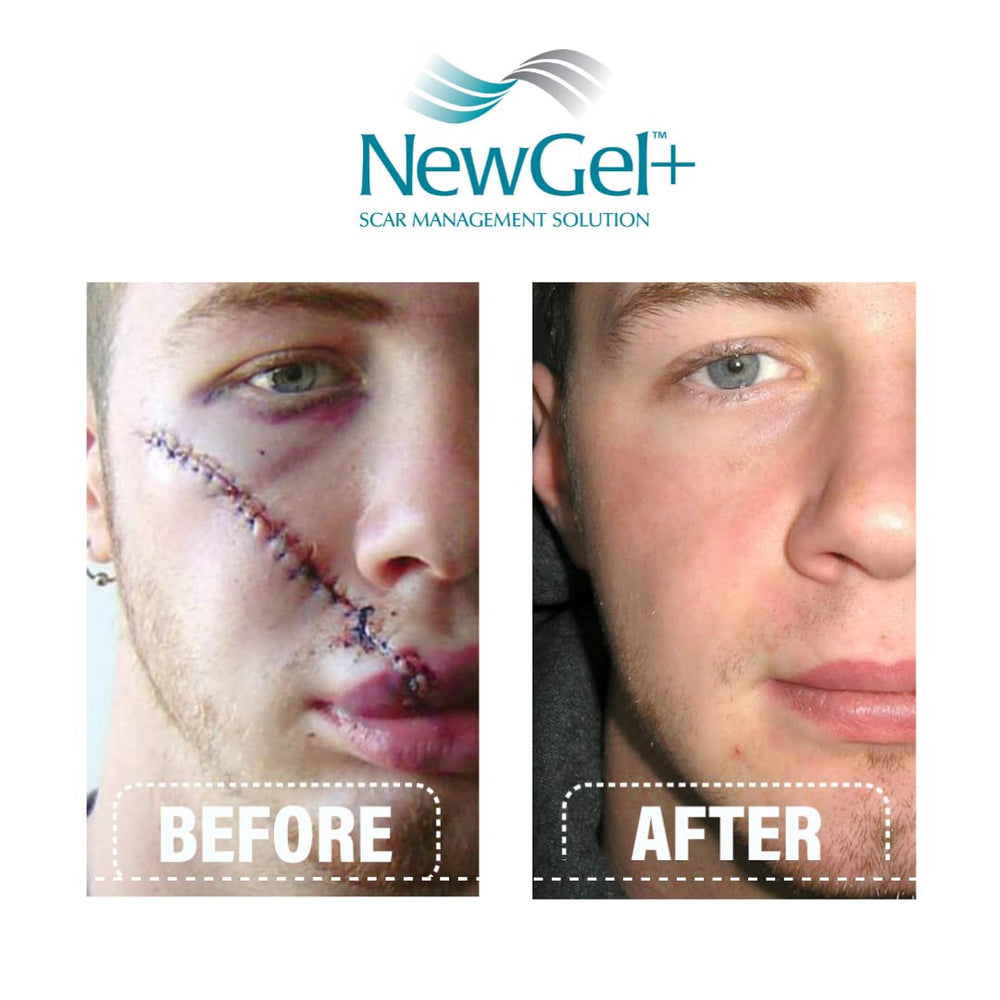 Skin-area application close-up shows gentle spread over healing scars