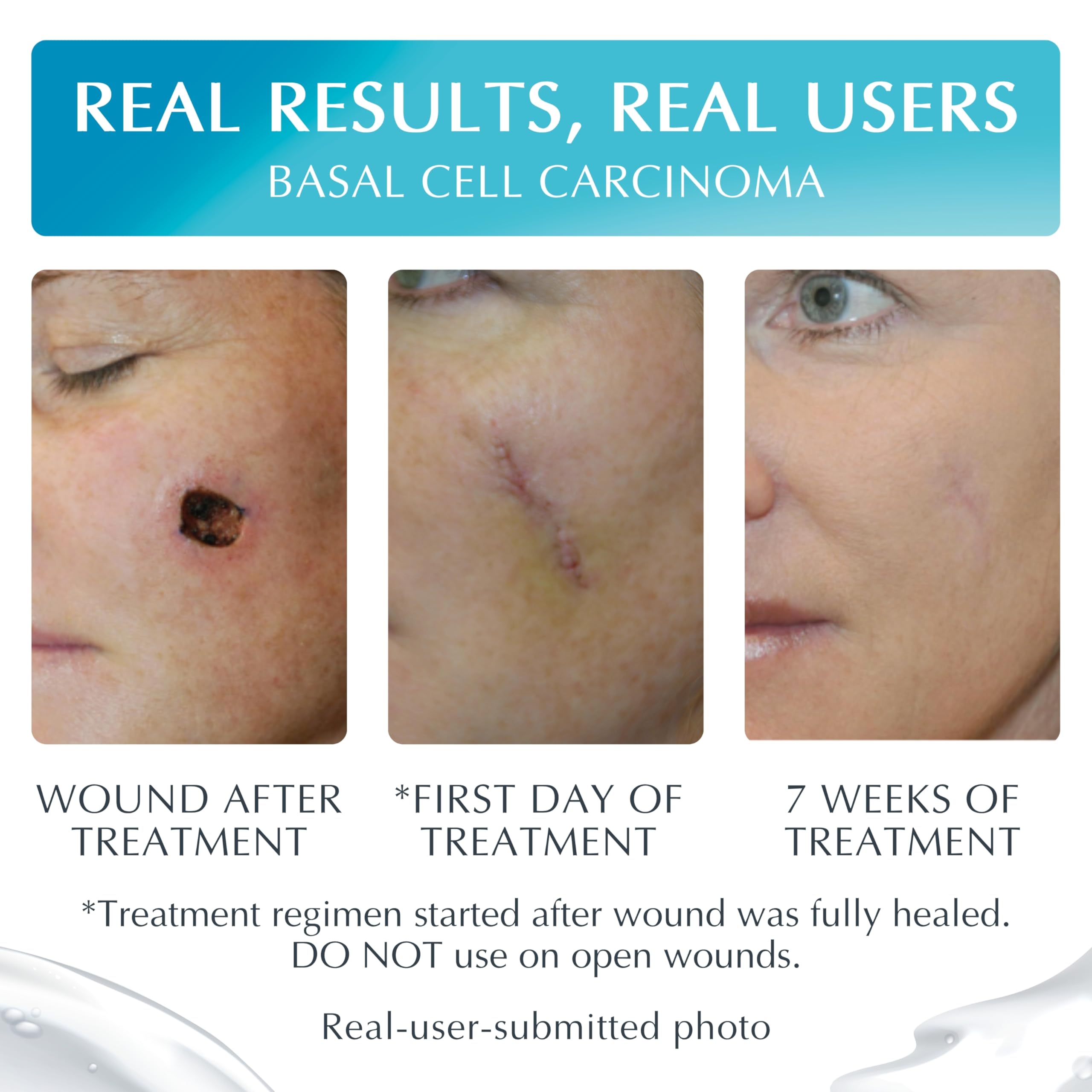 Vitamin E ingredient label highlights added nourishment for skin-friendly scar care