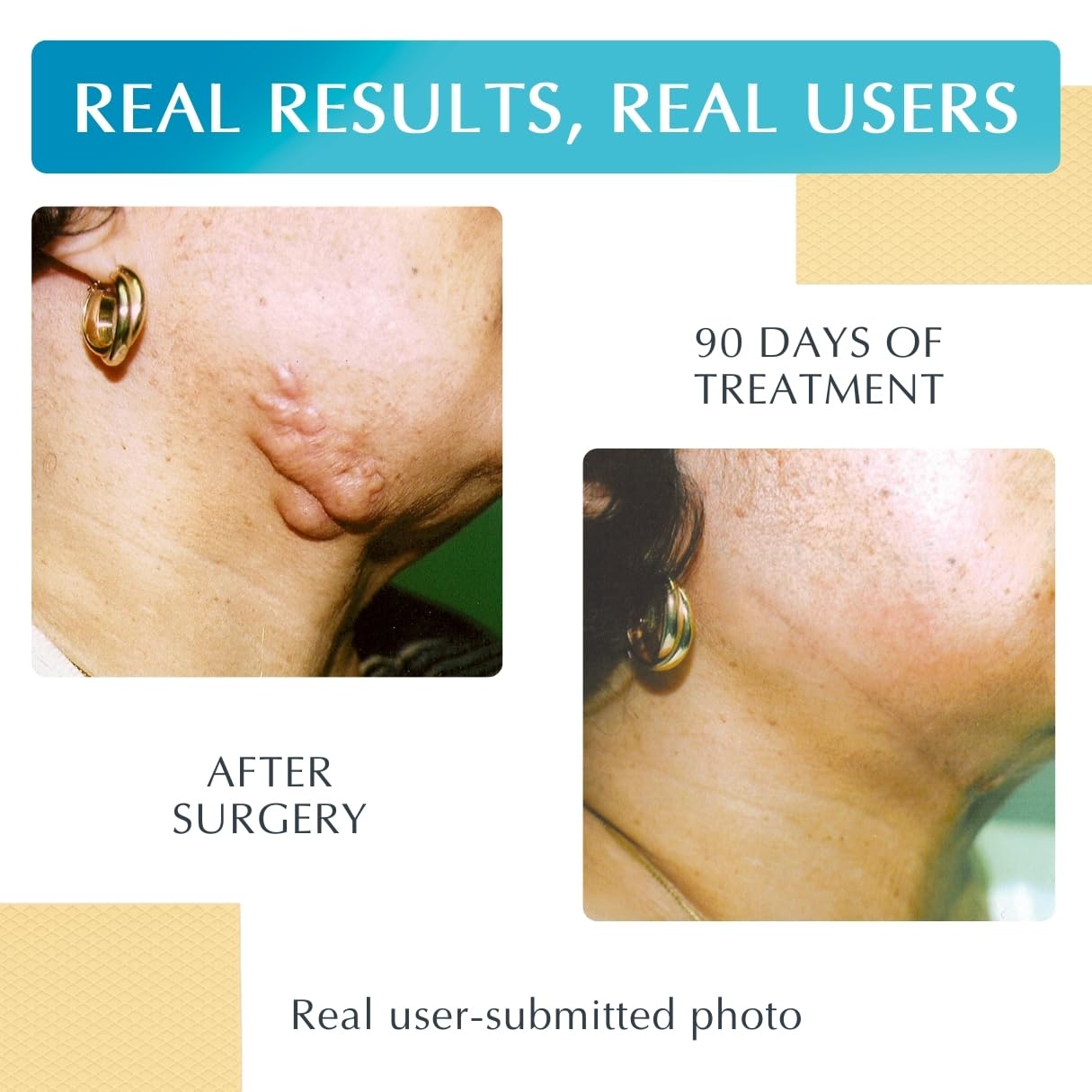 MyNewGel scar sheet applied on skin in beige for discreet coverage