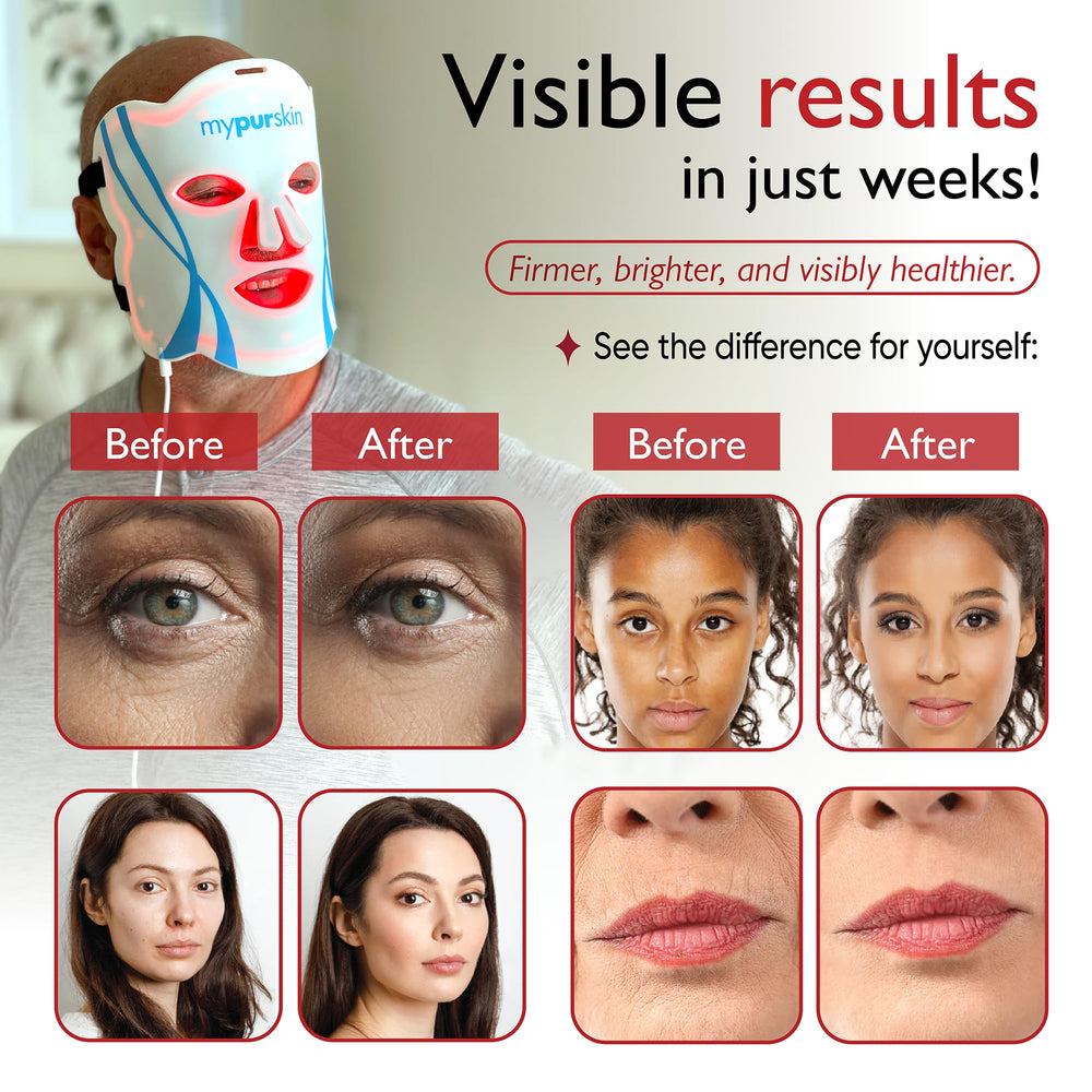 mypurskin Pro Grade Mask eye shades secure a comfortable fit.