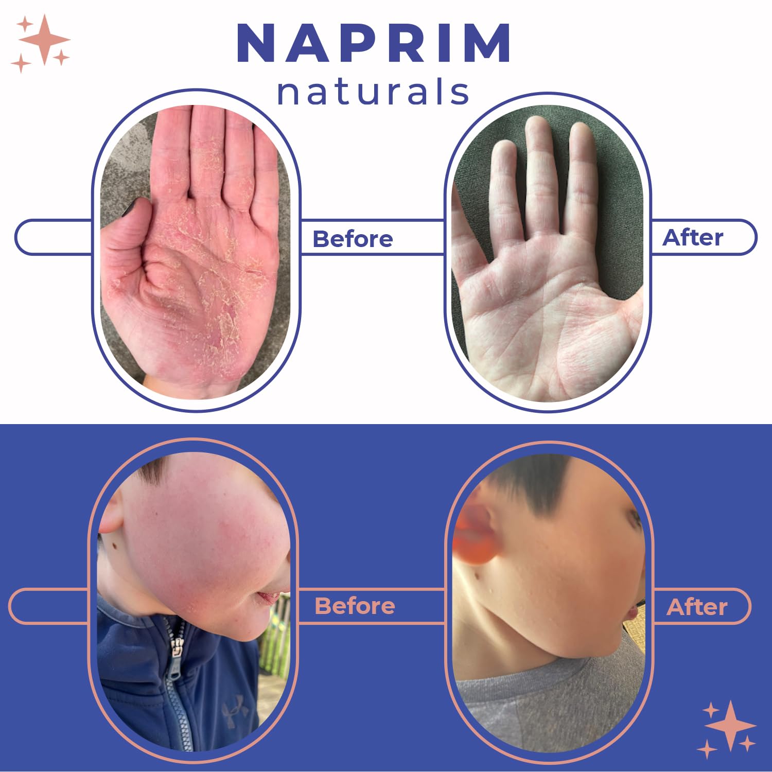 Naprim Naturals Nourishing Powder on irritated skin demonstrates soothing coverage for irritation.