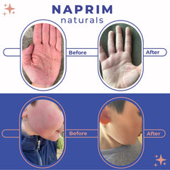 Naprim Naturals Nourishing Powder on irritated skin demonstrates soothing coverage for irritation.