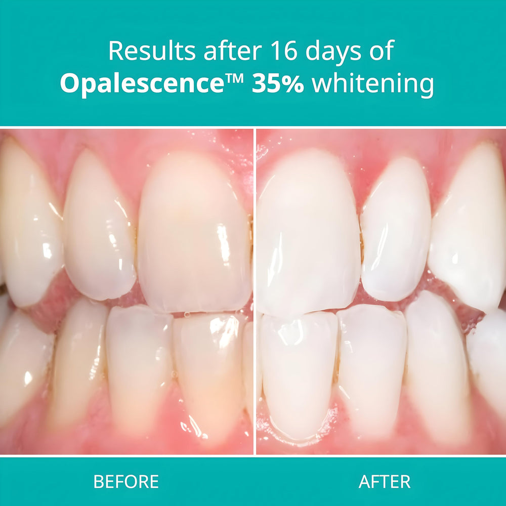 Opalescence syringe in whitening tray for easy gel delivery.