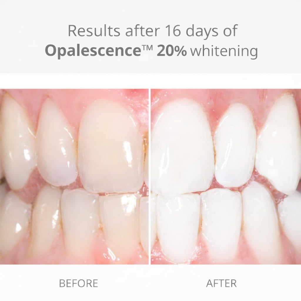 Opalescence syringes made in USA for professional-grade home whitening.