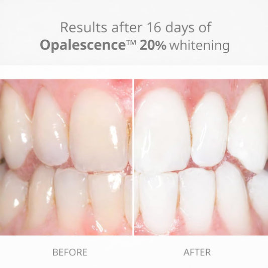 Opalescence syringes made in USA for professional-grade home whitening.