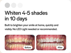 Opalescence tray compatibility with Invisalign and other dental trays.
