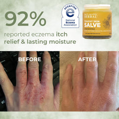 Unscented Touchy Skin Salve for fragrance-free eczema care.