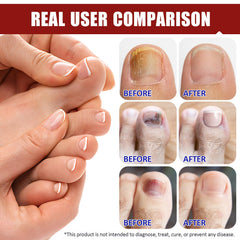 O.SECERT patches support nightly treatment for toenails
