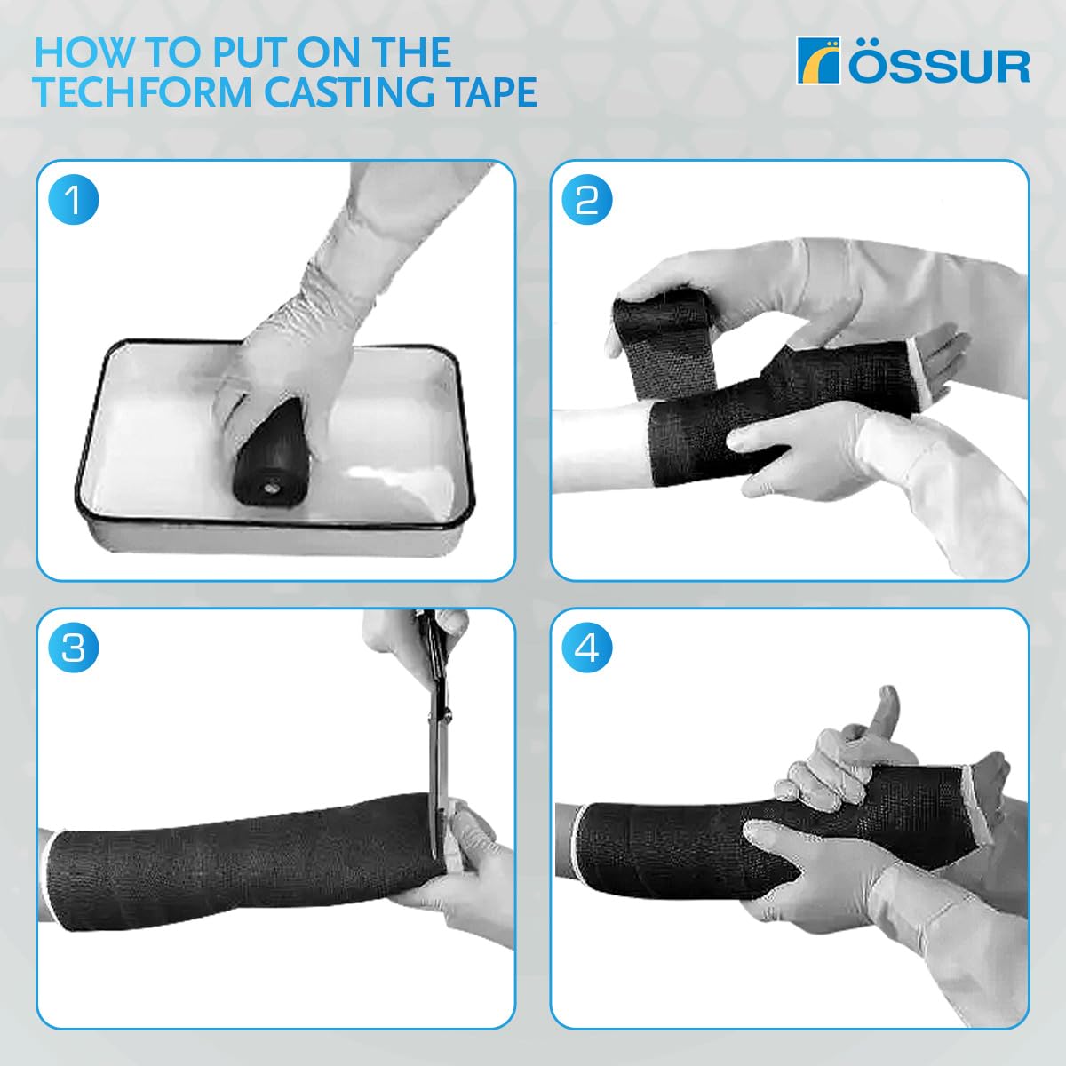 Össur Techform Premium Casting Tape on a patient arm illustrates quick, comfortable casting for immobilization.