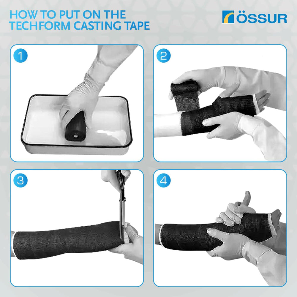 Össur Techform Premium Casting Tape on a patient arm illustrates quick, comfortable casting for immobilization.