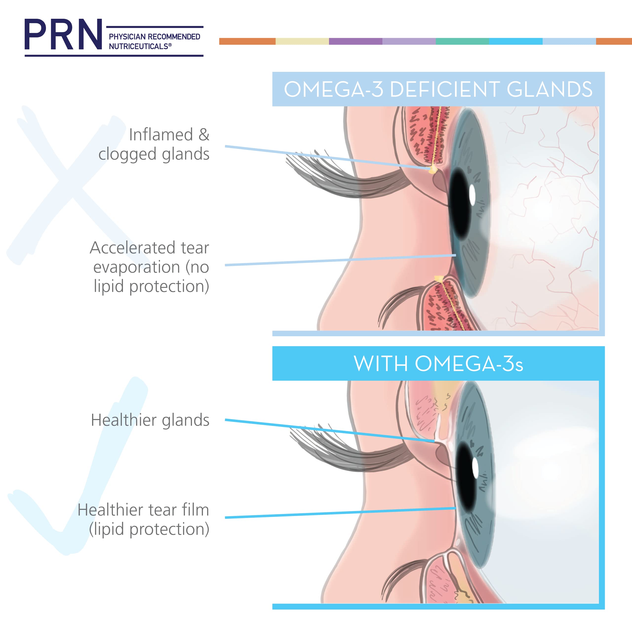 PRN DE Omega tear-film scene suggests potential eye comfort.