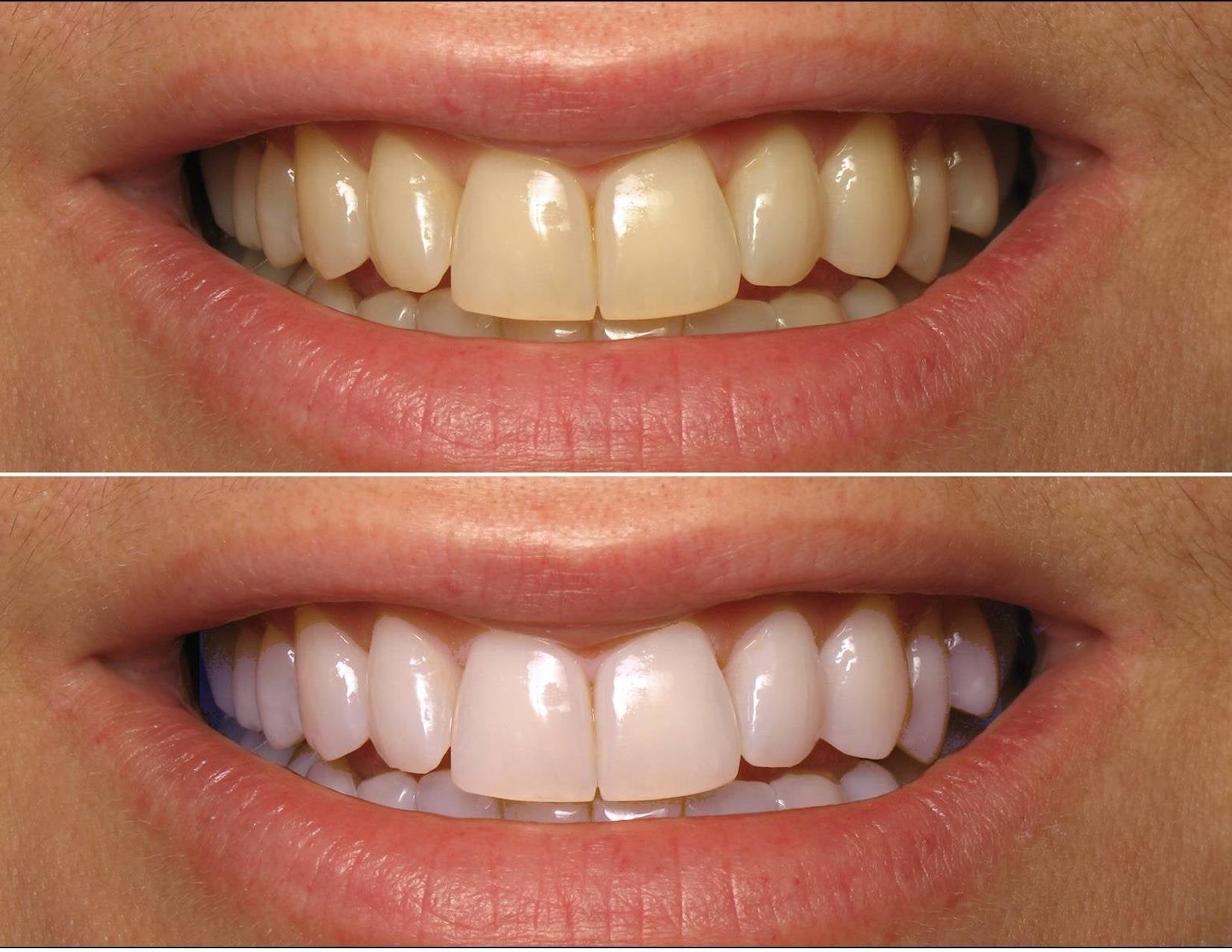 ProDental 35% carbamide peroxide gel ready for effective stain removal